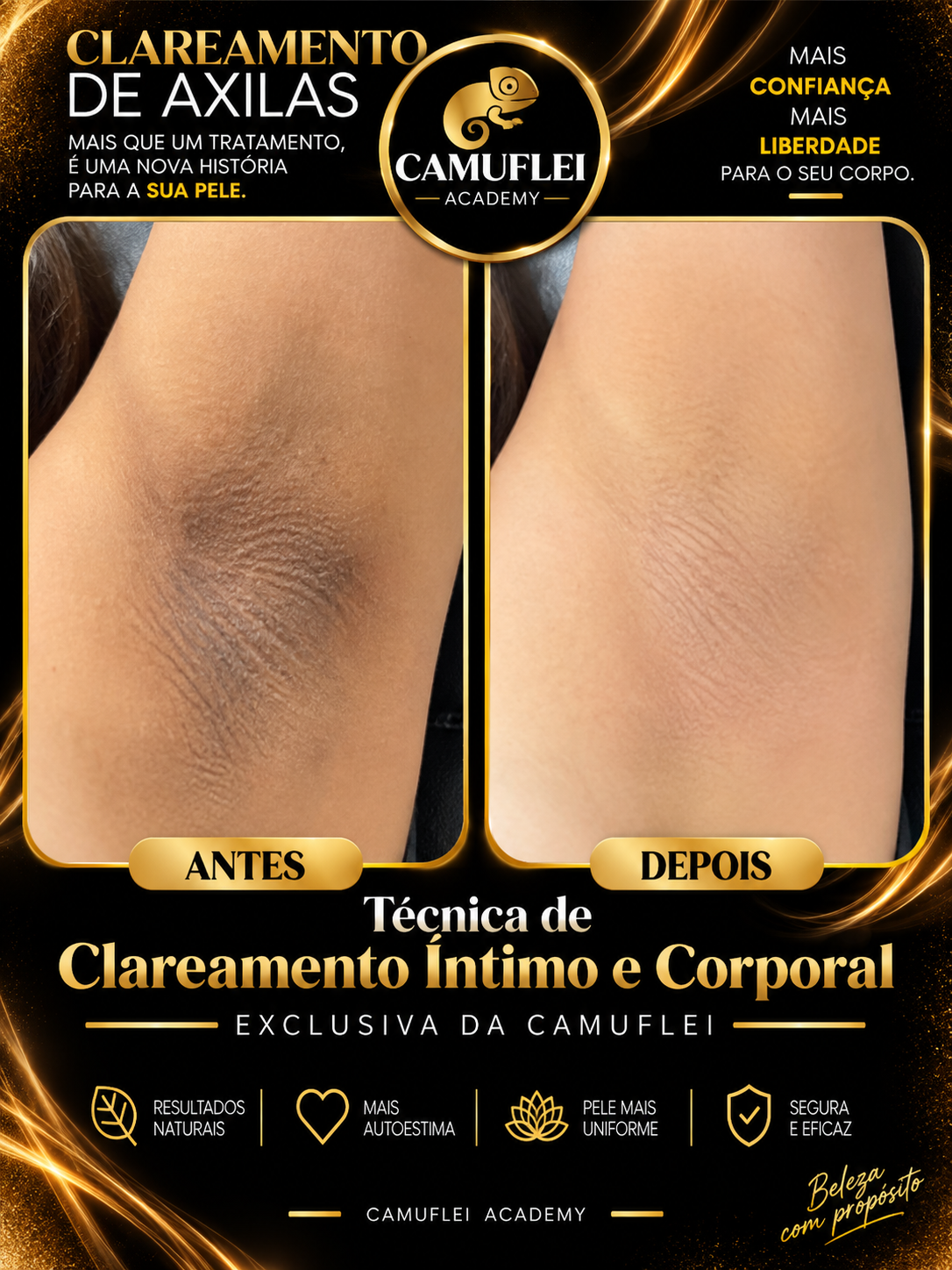 Resultado real de Clareamento de axilas, comparação antes e depois